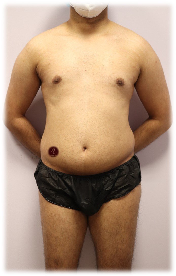 360° abdomen and waist liposuction — Before · front view