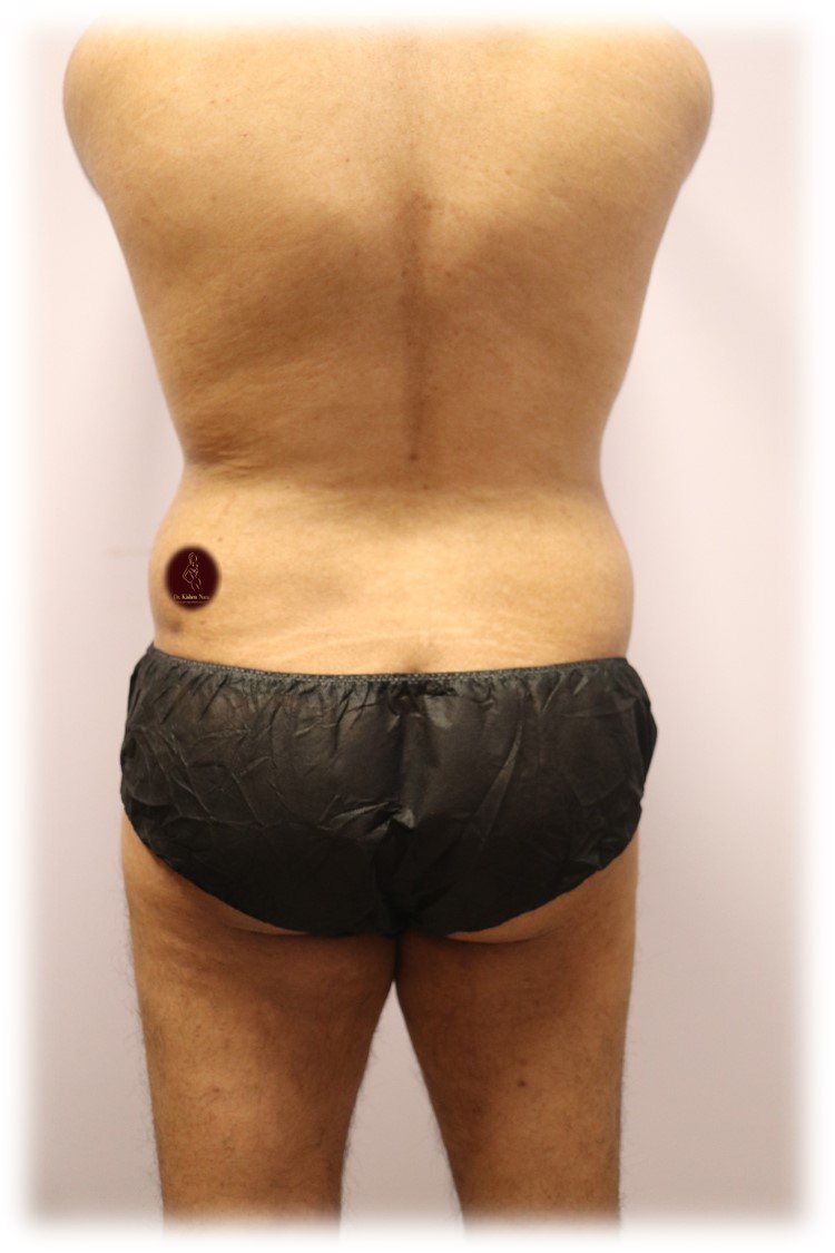 360° abdomen and waist liposuction — Before · third angle