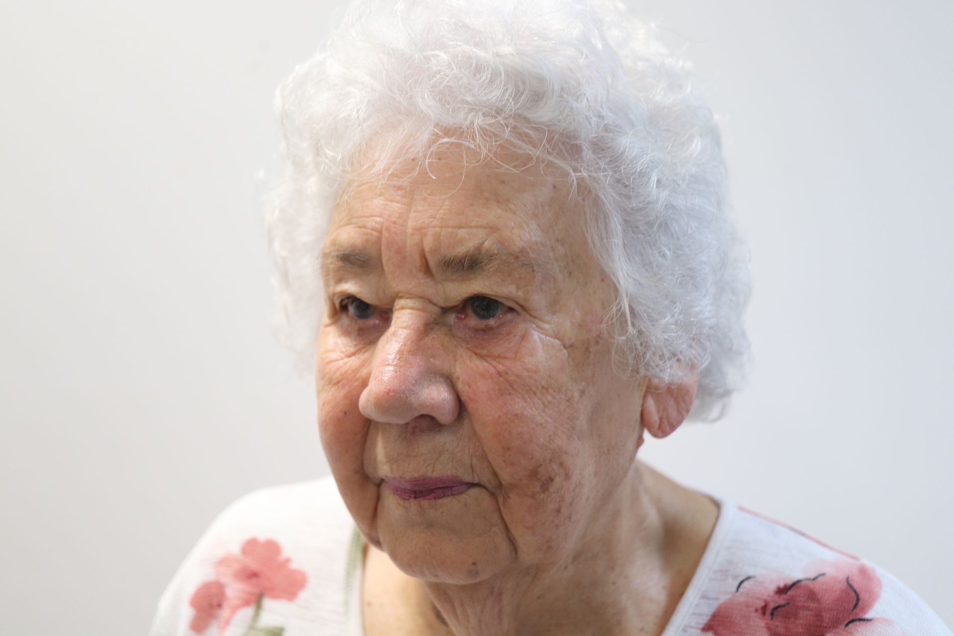 Upper eyelid lift — 3 weeks post-procedure — before