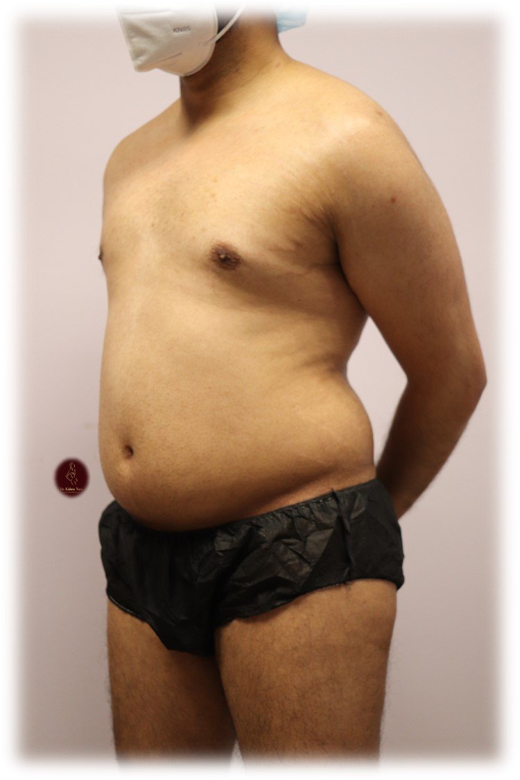360° abdomen and waist liposuction — Before · oblique view