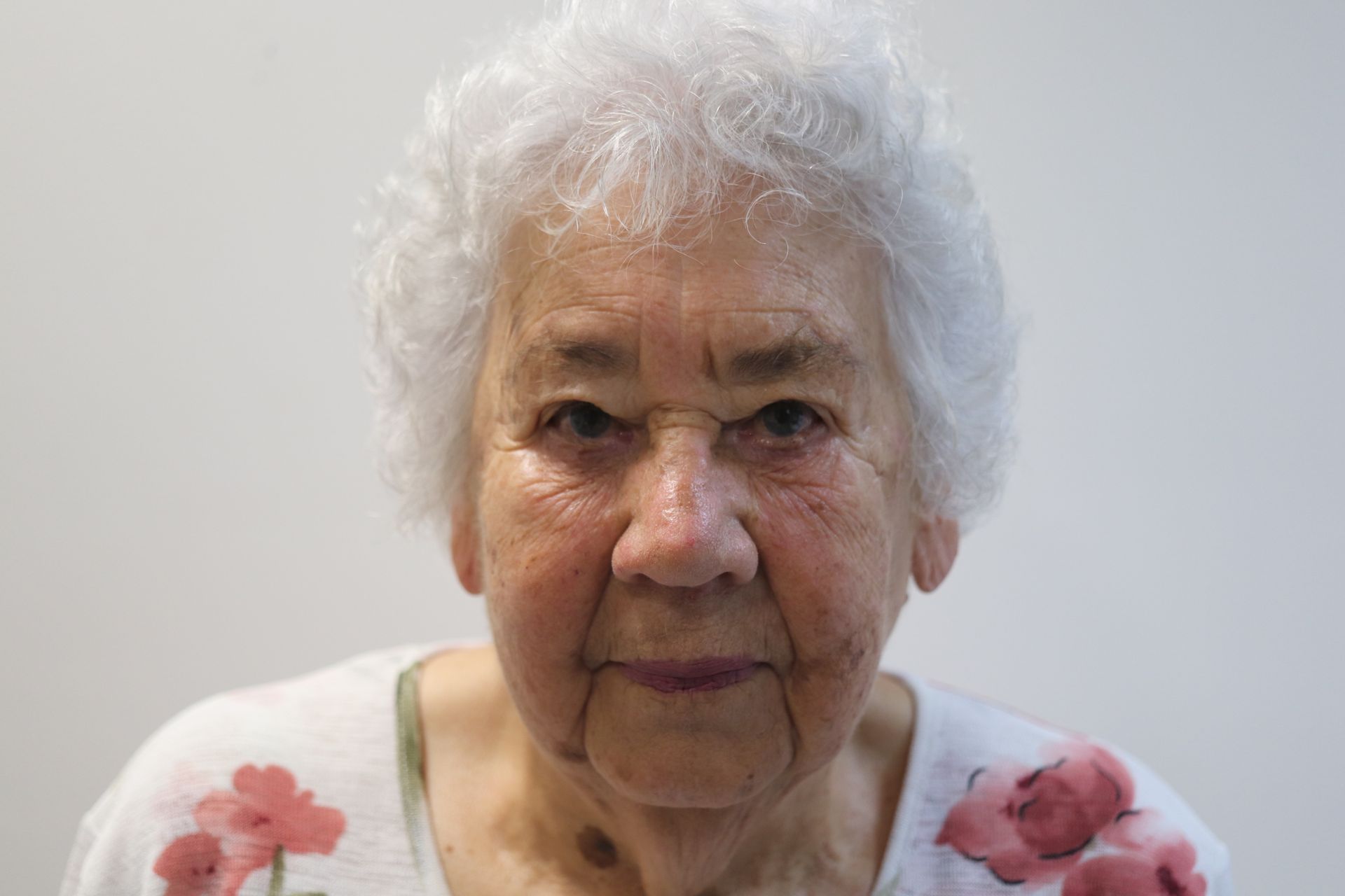 Upper eyelid lift blepharoplasty — 3 weeks post-procedure — before