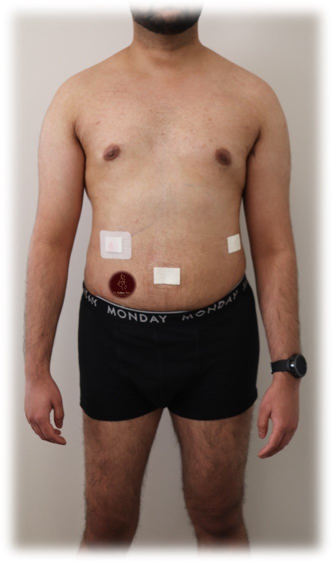 360° abdomen and waist liposuction — After · front view