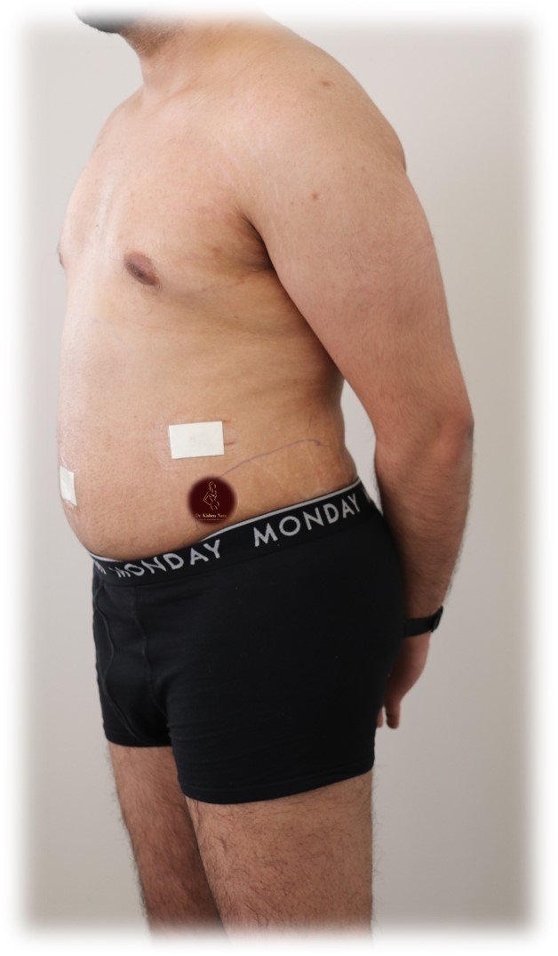 360° abdomen and waist liposuction — After · oblique view