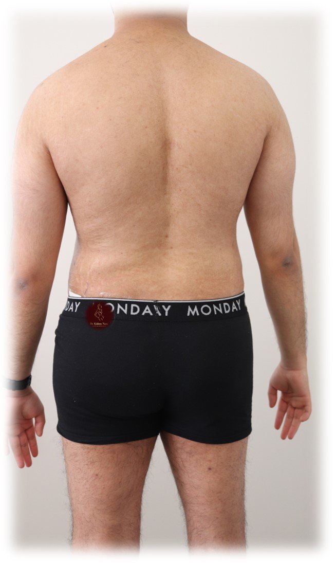 360° abdomen and waist liposuction — After · third angle