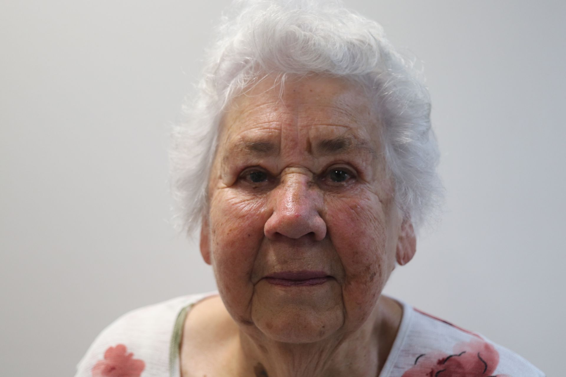 Upper eyelid lift blepharoplasty — 3 weeks post-procedure — after