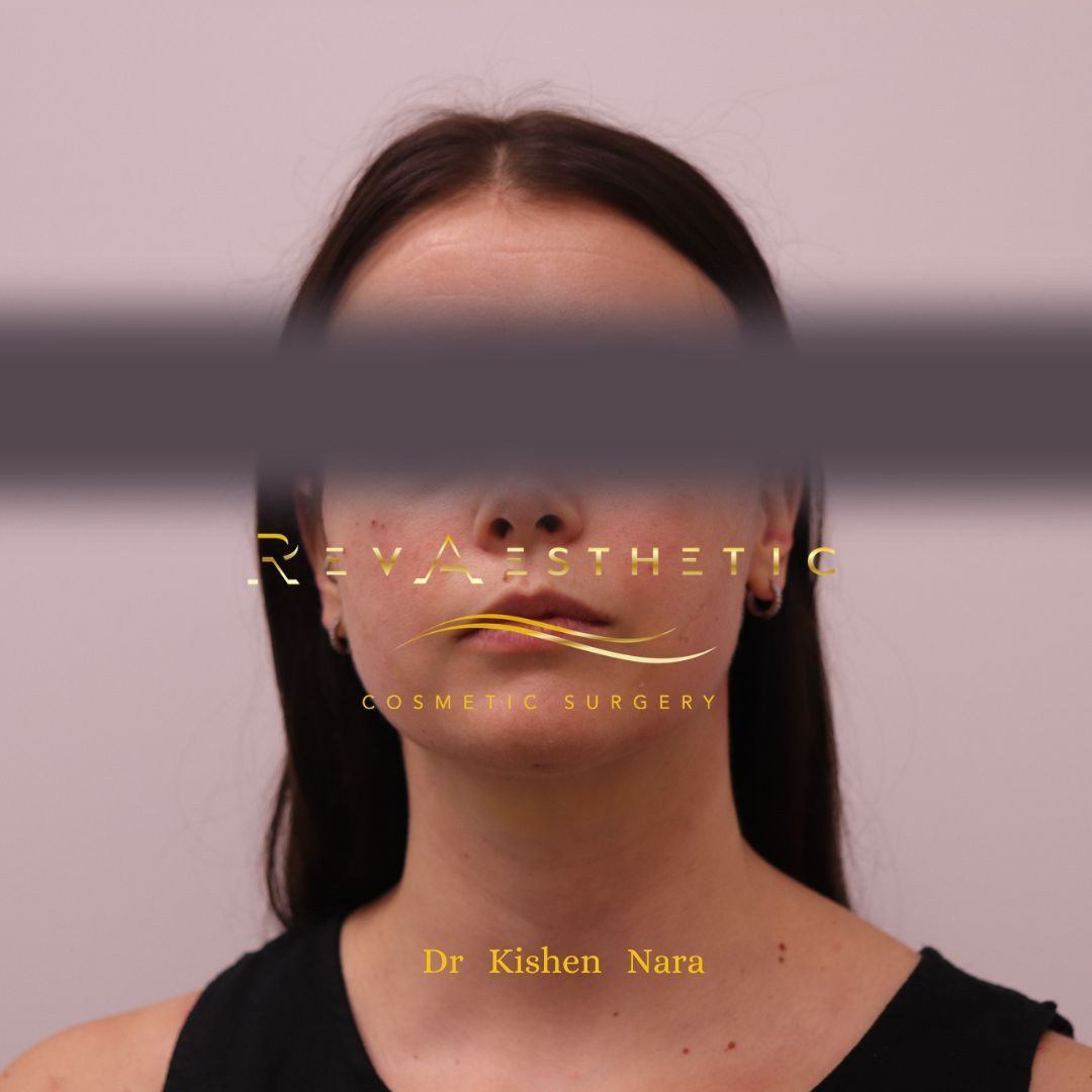 Submental (under-chin) liposuction — After · front view