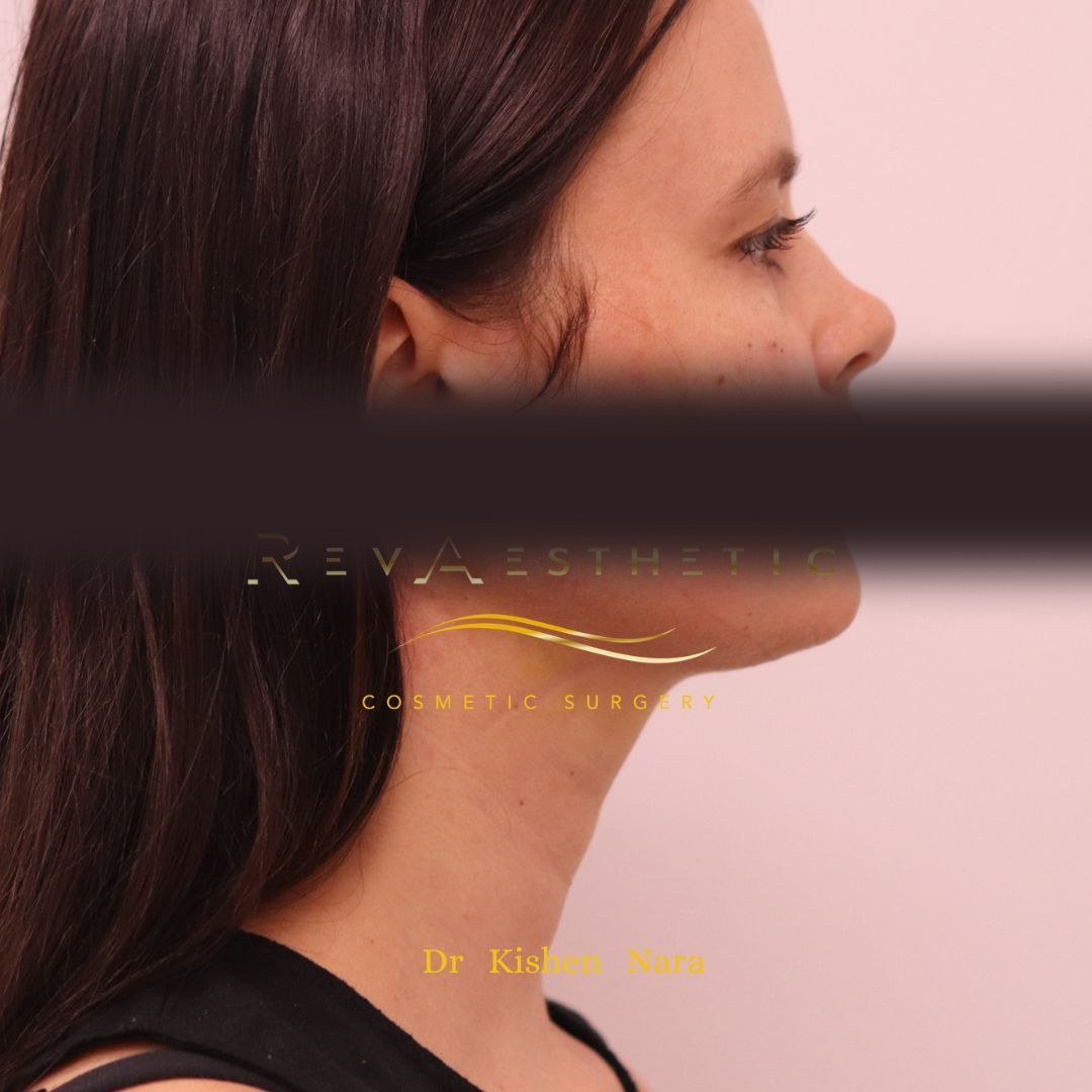 Submental (under-chin) liposuction — After · right profile