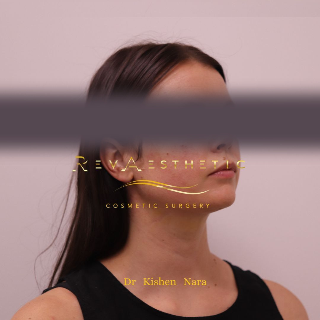 Submental (under-chin) liposuction — After · right oblique