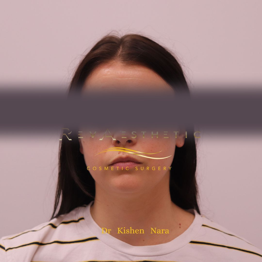 Submental (under-chin) liposuction — Before · front view