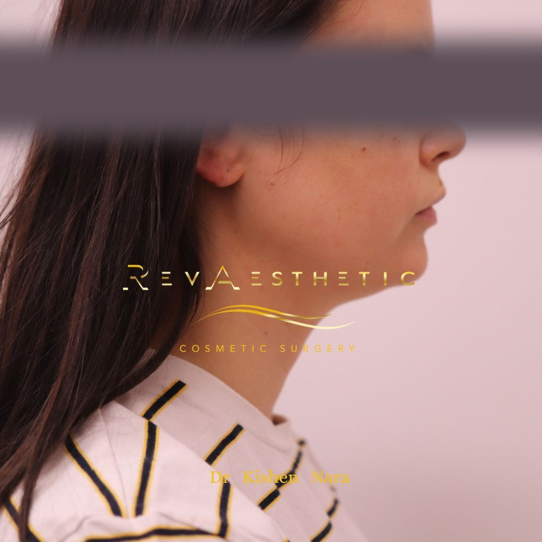 Submental (under-chin) liposuction — Before · right profile