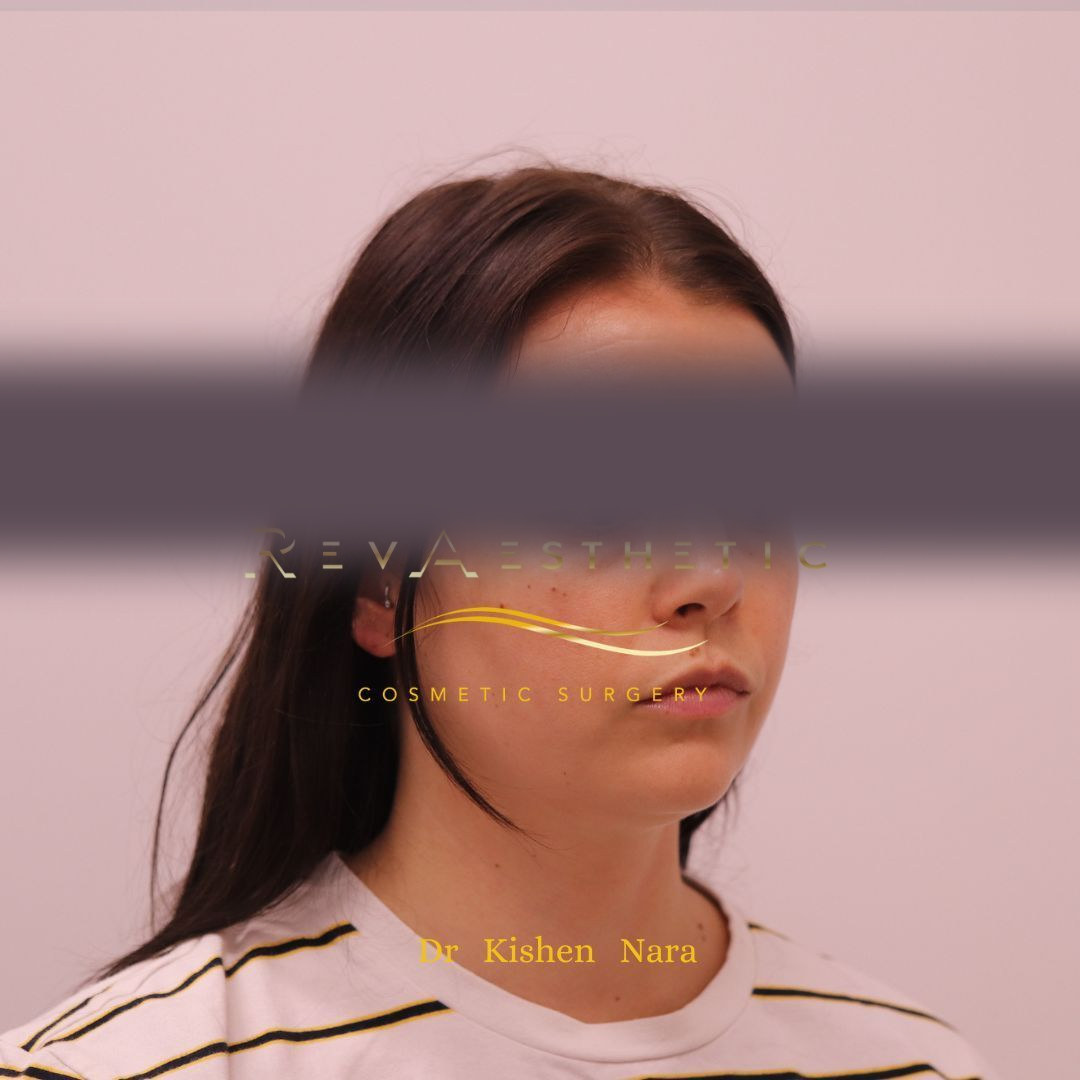 Submental (under-chin) liposuction — Before · right oblique