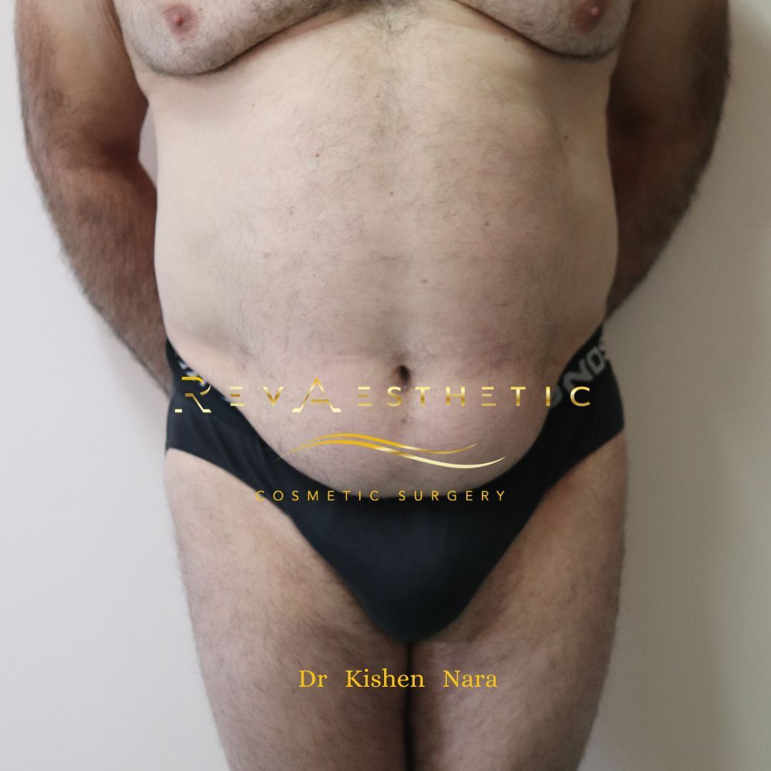 360° abdomen liposuction — Before · front view