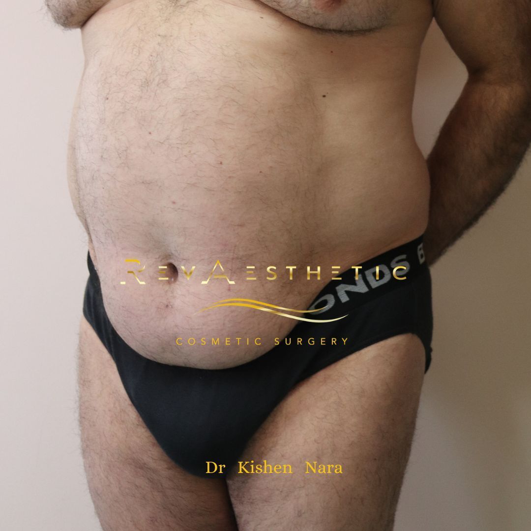 360° abdomen liposuction — Before · left oblique