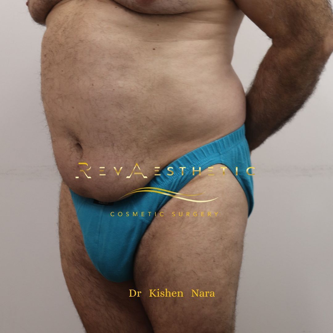 360° abdomen liposuction — After · left oblique