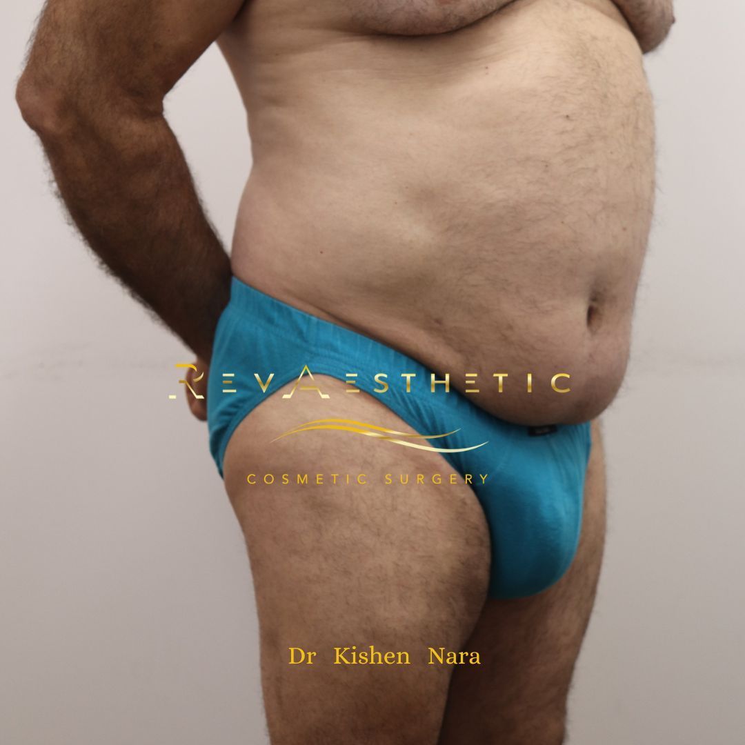 360° abdomen liposuction — After · right oblique