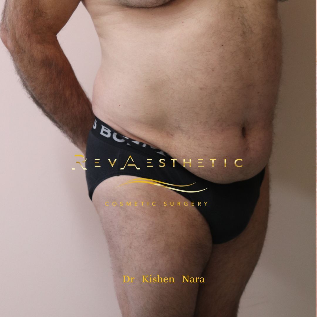 360° abdomen liposuction — Before · right oblique