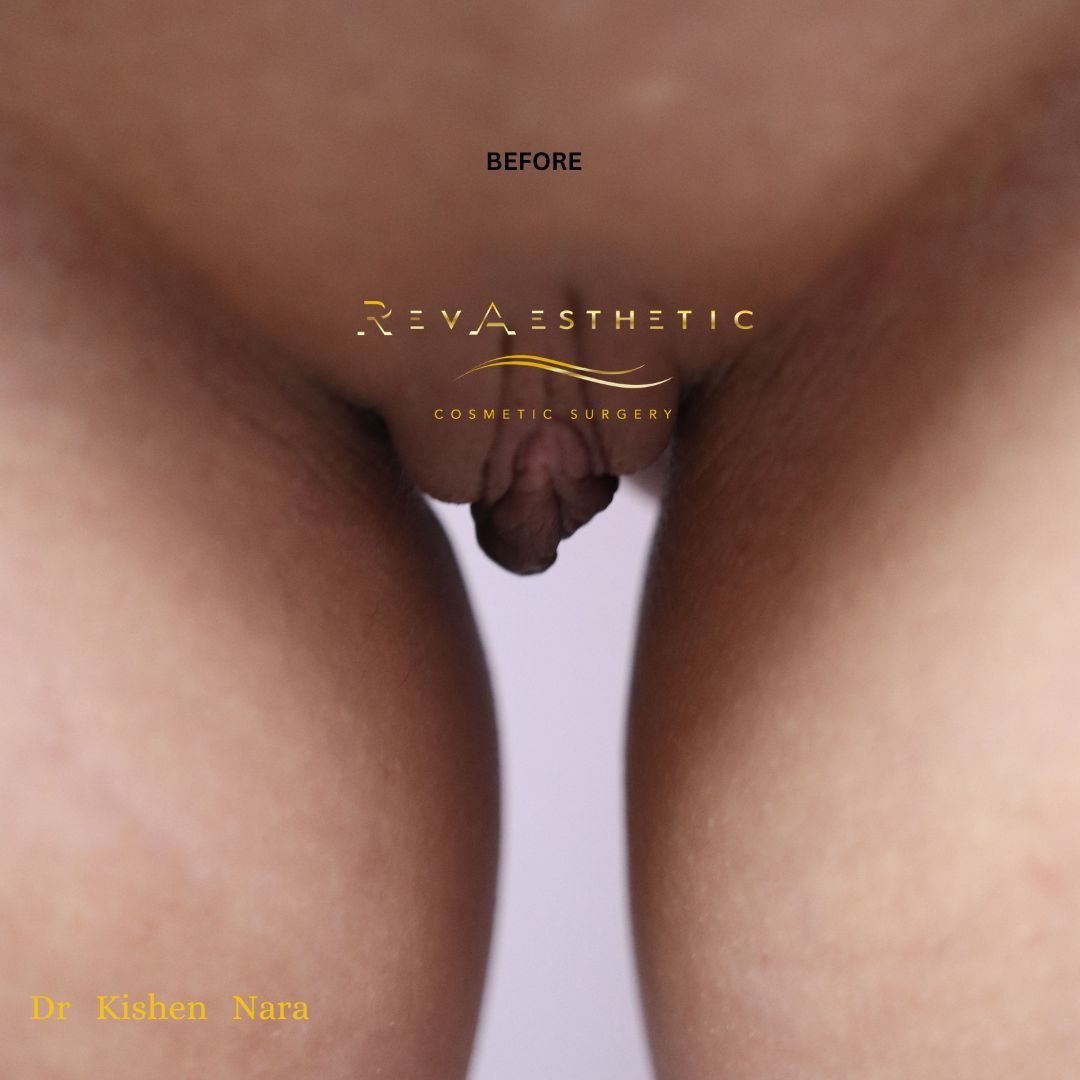 SAP labiaplasty — before