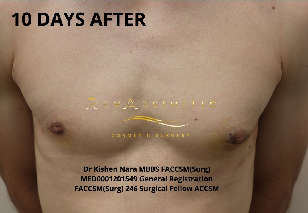 Liposuction + subcutaneous mastectomy + areolar reduction — Anterior view — after