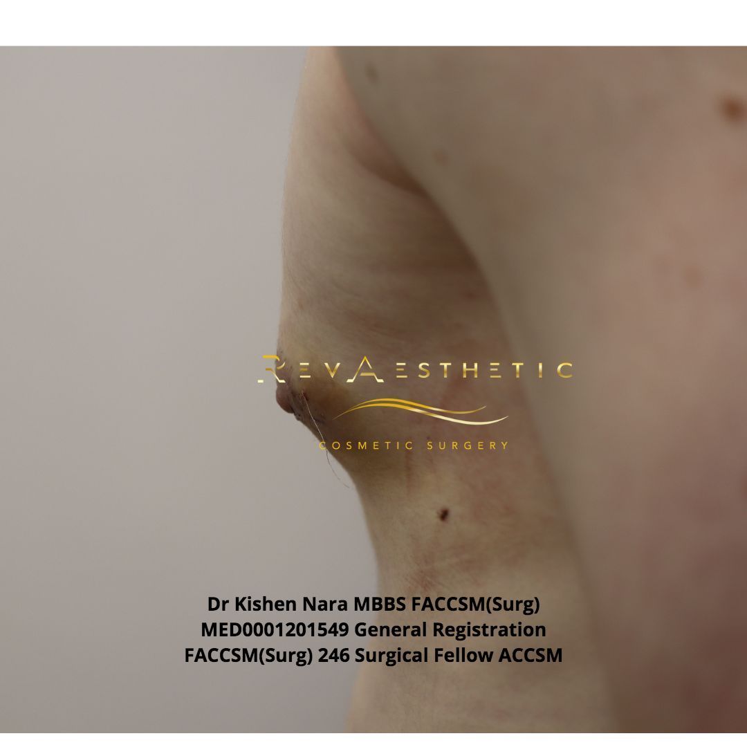 Liposuction + subcutaneous mastectomy + areolar reduction — left postero-oblique view — after