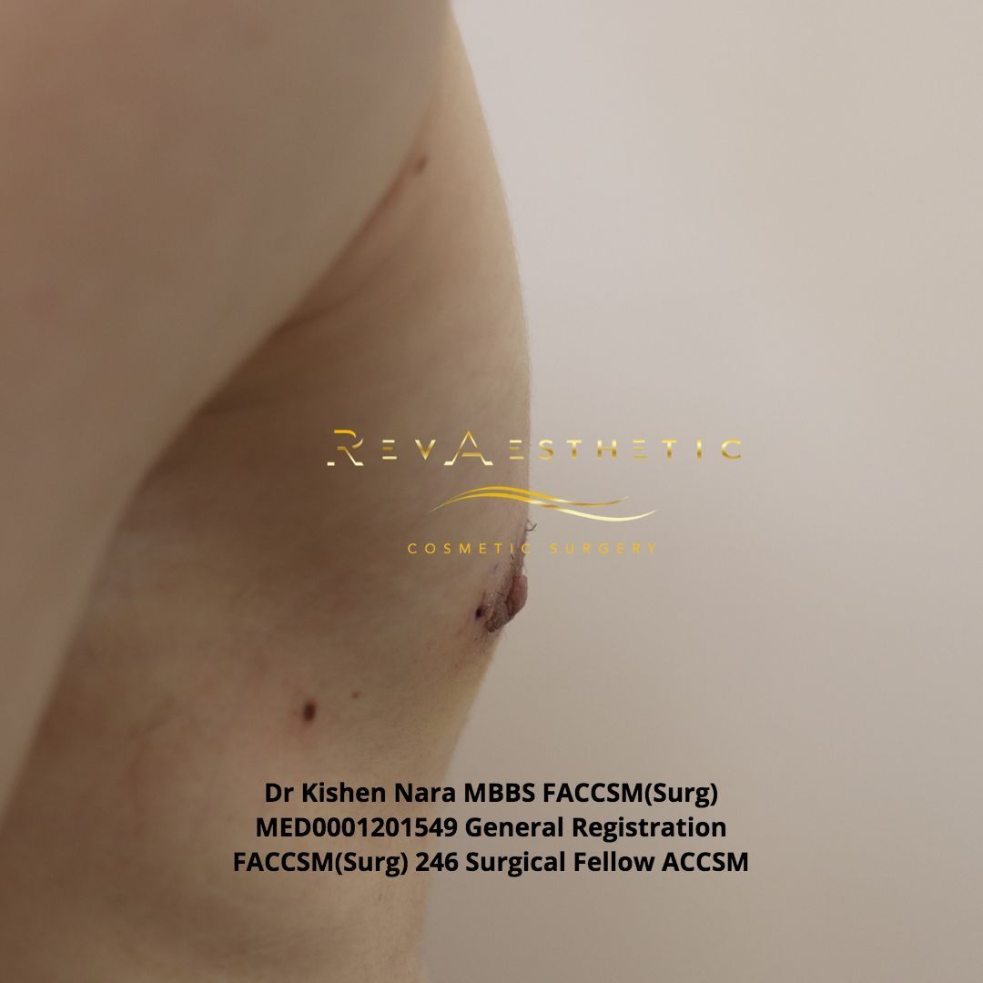 Liposuction + subcutaneous mastectomy + areolar reduction — right postero-oblique view — after