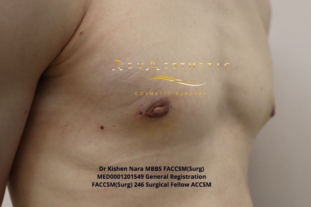 Liposuction + subcutaneous mastectomy — Oblique view — after