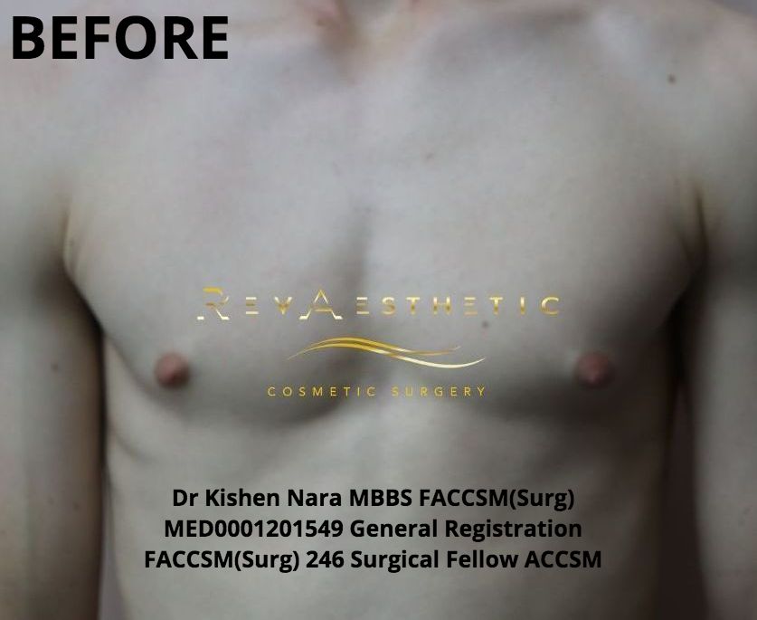 Liposuction + subcutaneous mastectomy + areolar reduction — Anterior view — before