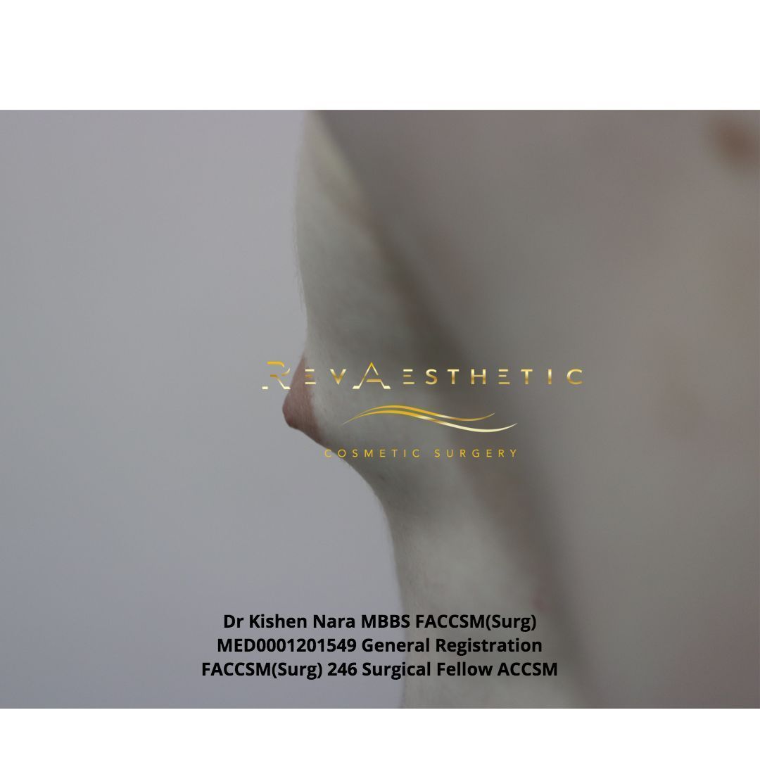 Liposuction + subcutaneous mastectomy + areolar reduction — left postero-oblique view — before