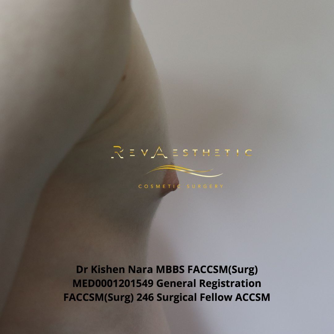 Liposuction + subcutaneous mastectomy + areolar reduction — right postero-oblique view — before