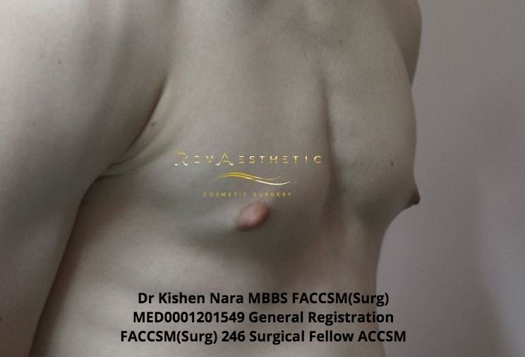 Liposuction + subcutaneous mastectomy — Oblique view — before