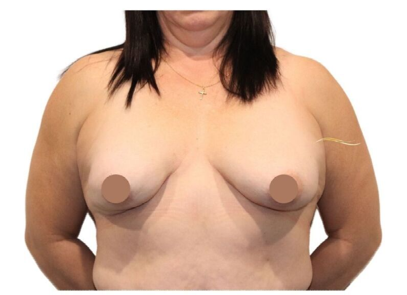 Breast implant removal — front view — 42-year-old patient — after