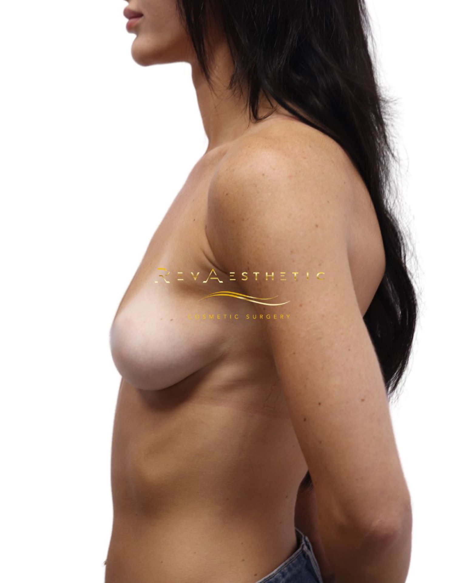 Breast augmentation (subfascial plane) — lateral view — Lateral view — before
