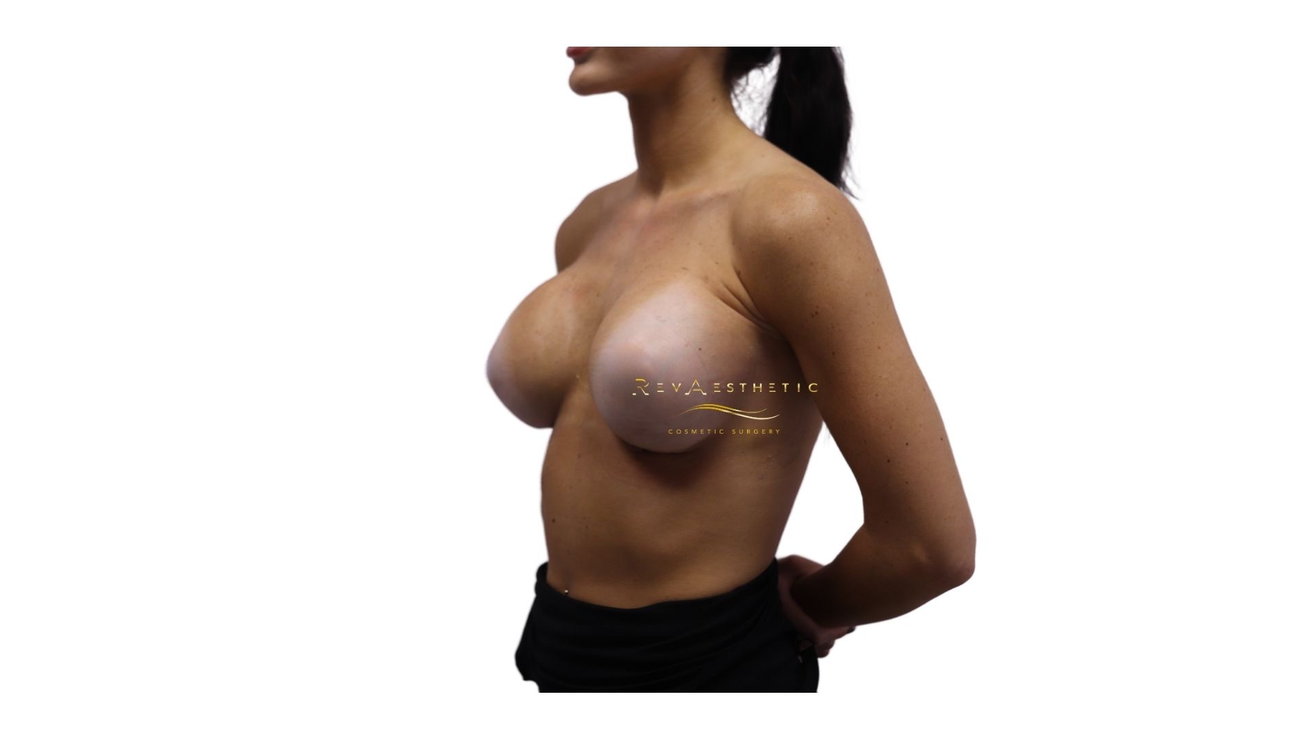 Breast augmentation (subfascial plane) — Left oblique view — after