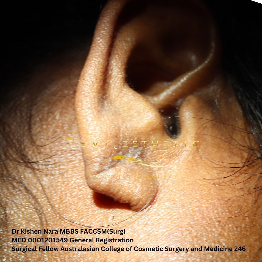 Ear lobe repair clinical photograph thumbnail