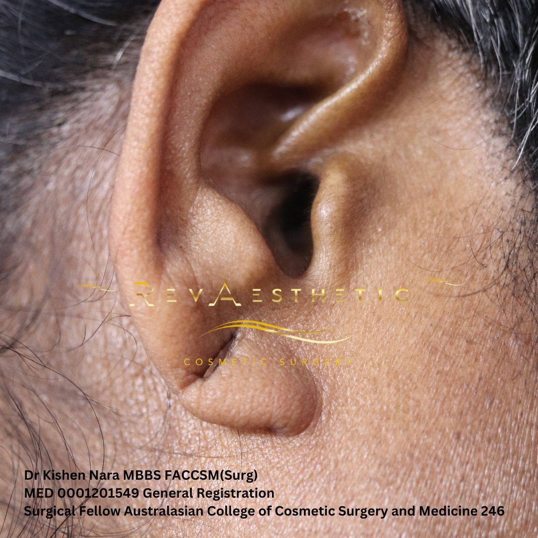 Ear lobe repair — patient one — 50-year-old patient — before