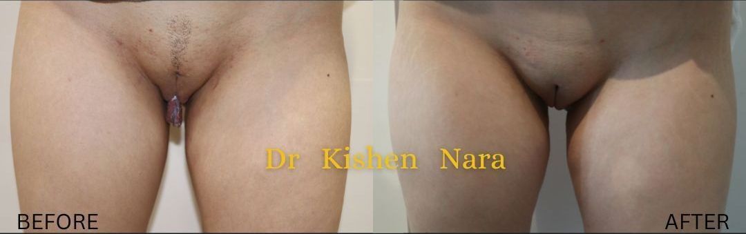 SAP labiaplasty — after
