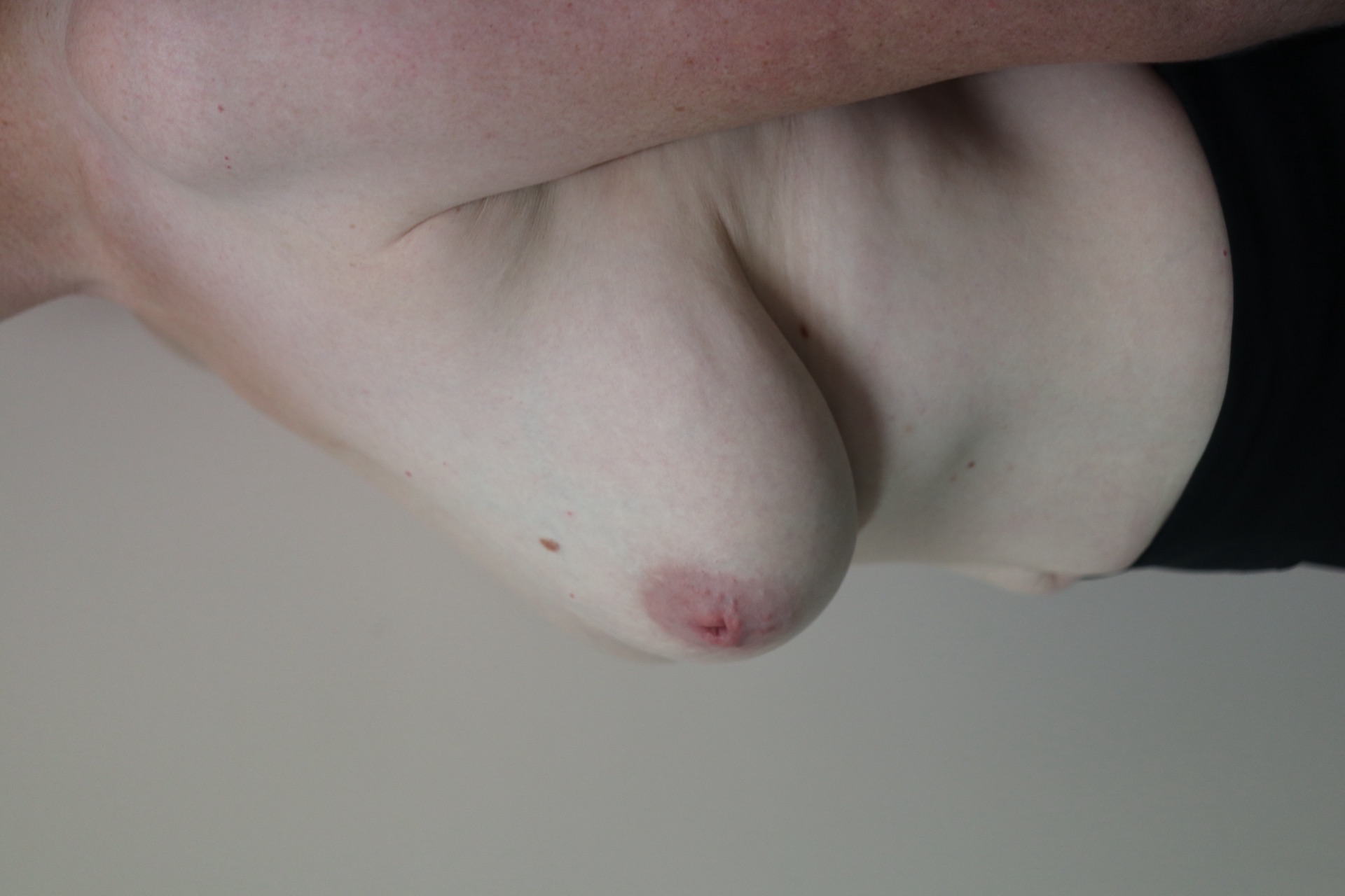Bilateral nipple inversion correction — separate patient — Separate patient — before