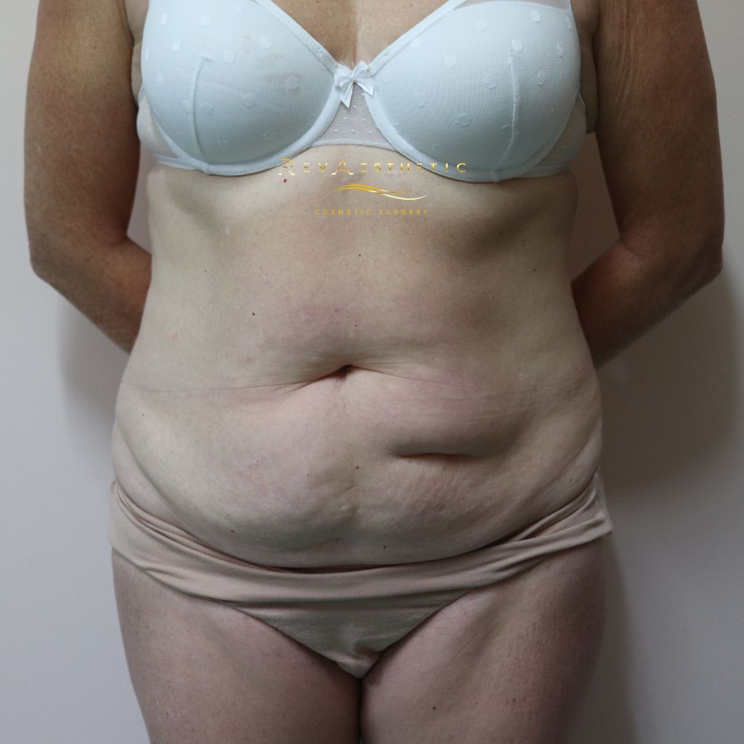 Tummy tuck (abdominoplasty) — front view — front view — before