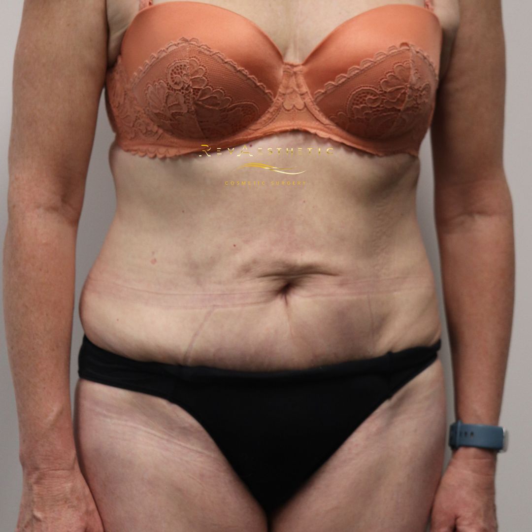 Tummy tuck (abdominoplasty) — front view — front view — after