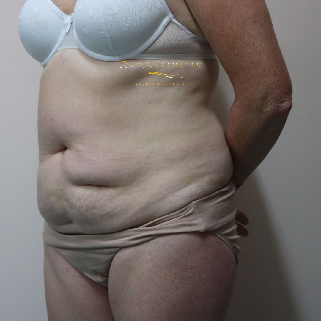 Tummy tuck (abdominoplasty) — left oblique — left oblique view — before