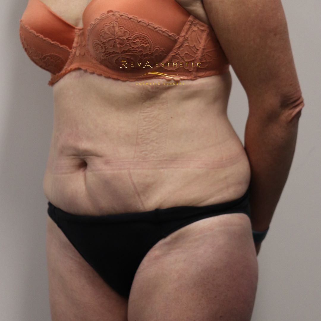 Tummy tuck (abdominoplasty) — left oblique — left oblique view — after