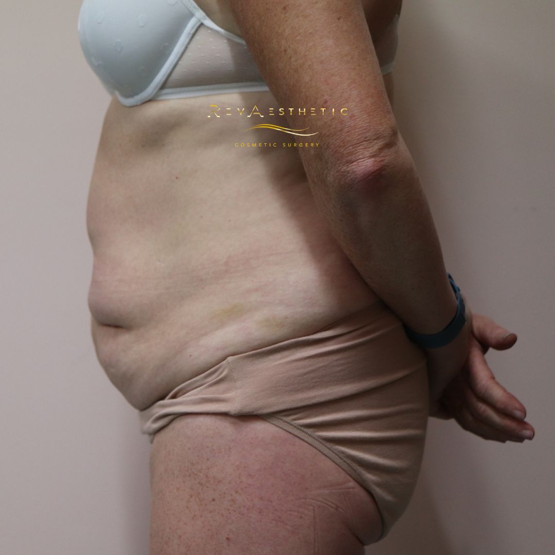Tummy tuck (abdominoplasty) — left lateral — left lateral view — before
