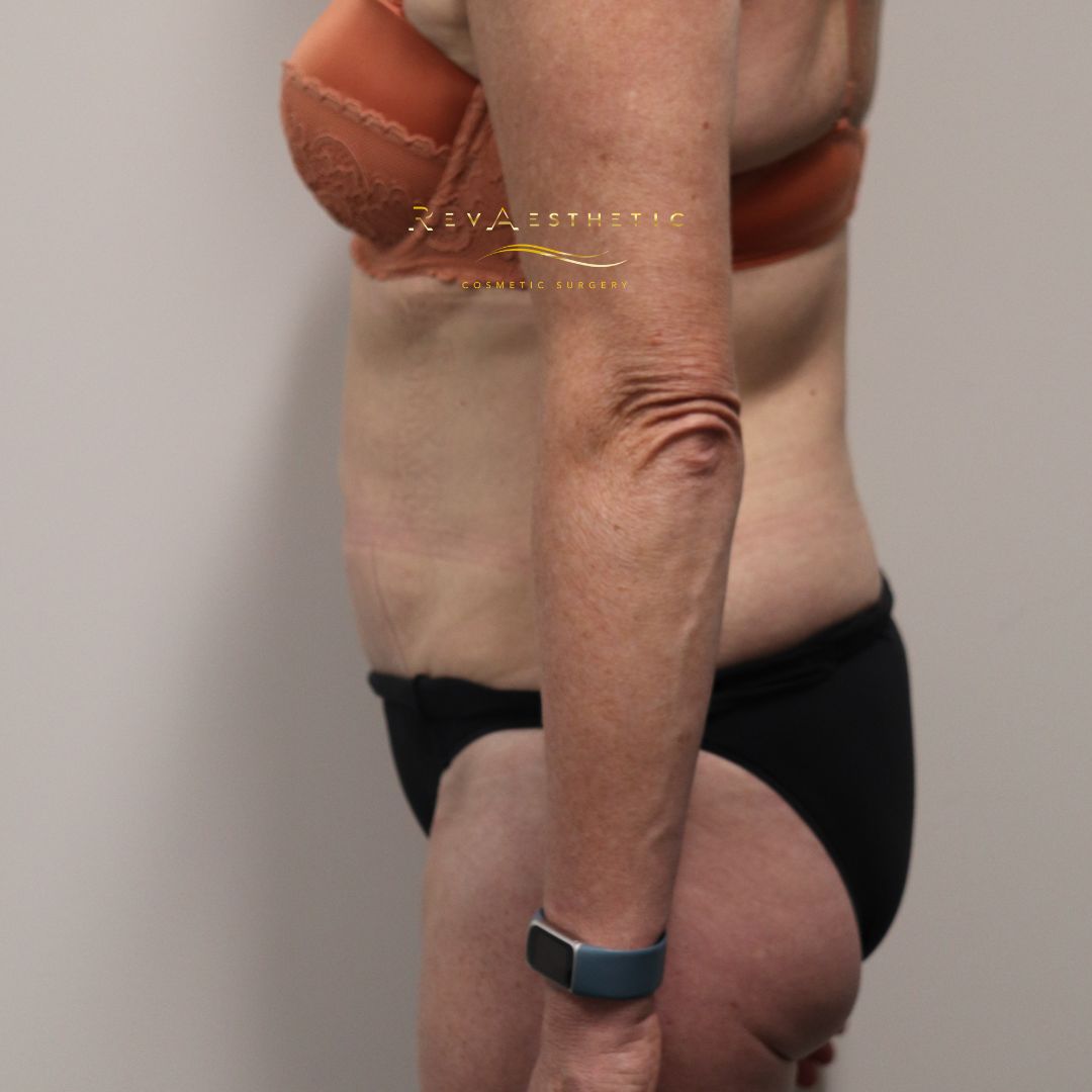 Tummy tuck (abdominoplasty) — left lateral — left lateral view — after