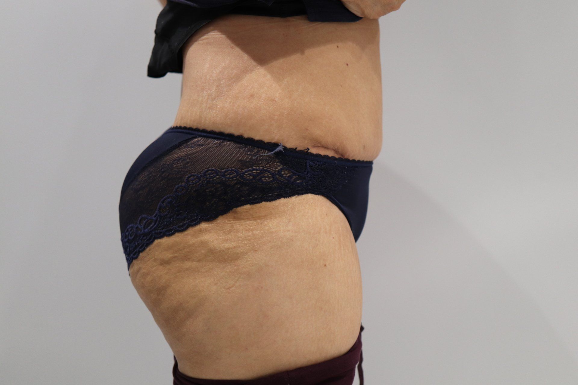 Tummy tuck (abdominoplasty) clinical photograph thumbnail