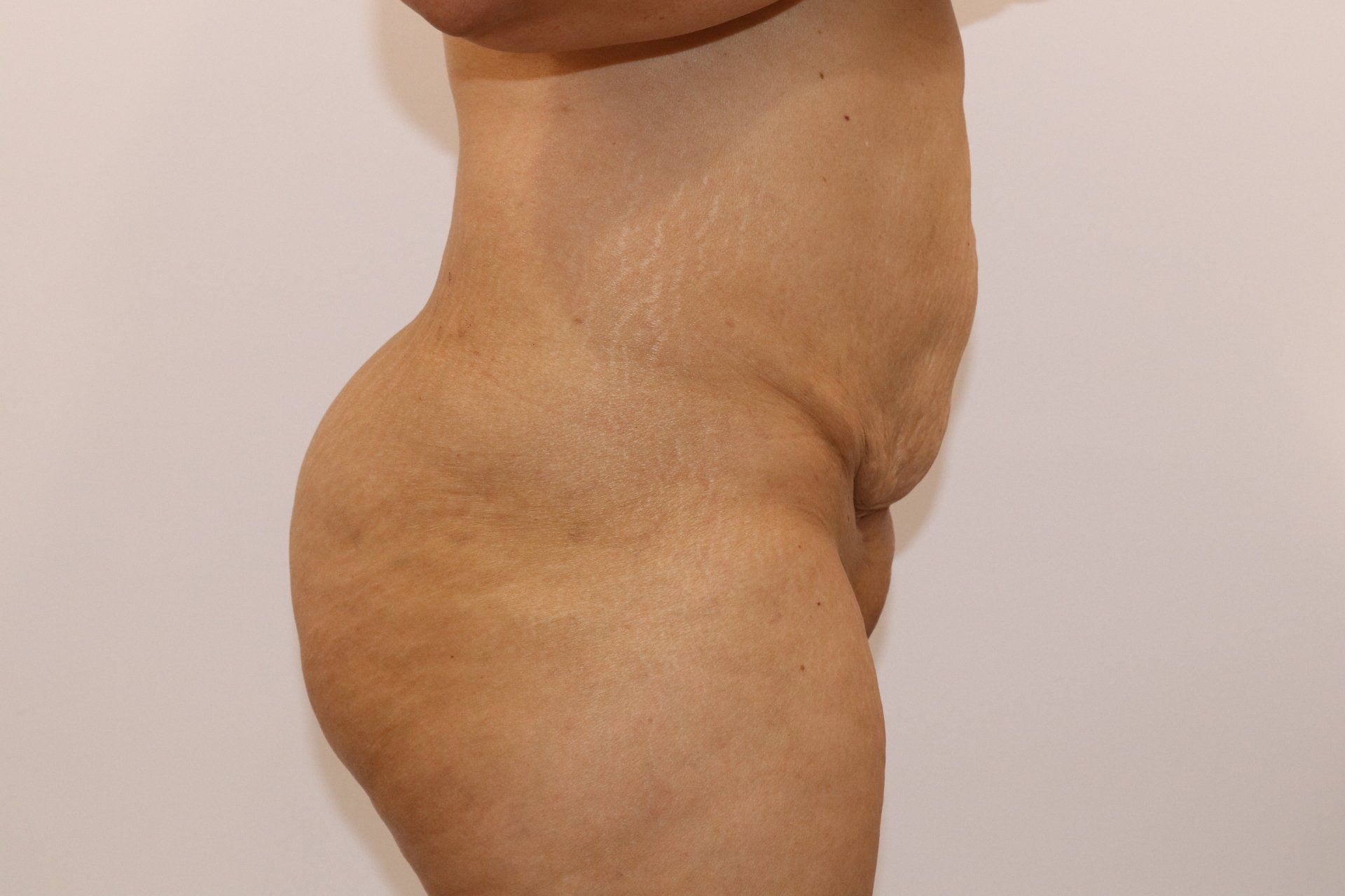 Tummy tuck (abdominoplasty) — right lateral — A hardworking mother, 57 years of age, who decided on limited minor abdominoplasty simultaneously with full abdominal liposuction. The challenge for her surgery was a previous scar visible on the BEFORE image — a meticulous analysis of soft tissue care was performed while protecting the anatomical structures at risk. The result was achieved with abdominoplasty plus liposuction. Shown at 9 weeks. Individual record, not a typical result. — before