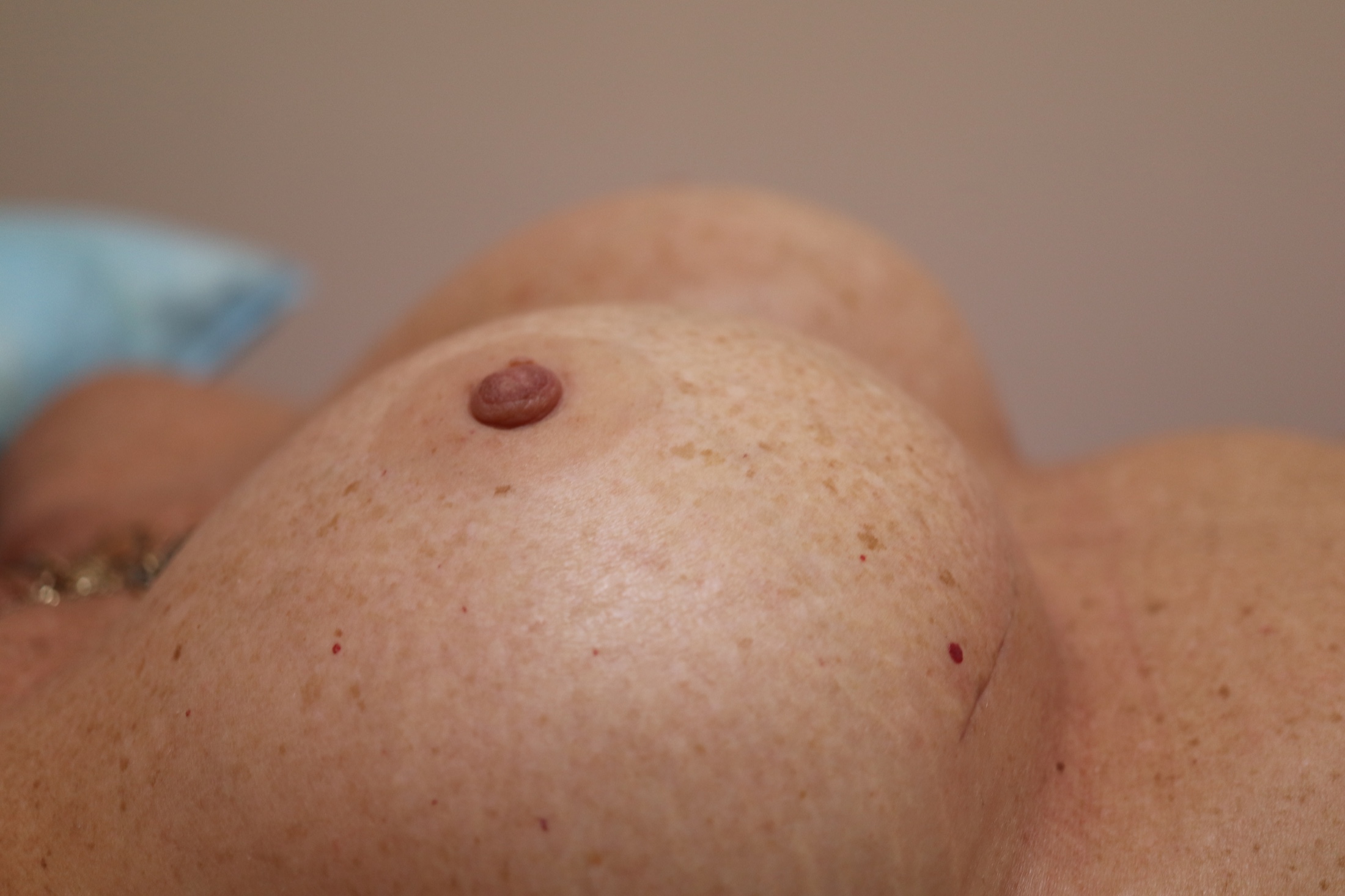 De-identified close-up follow-up view of breast contour and projection