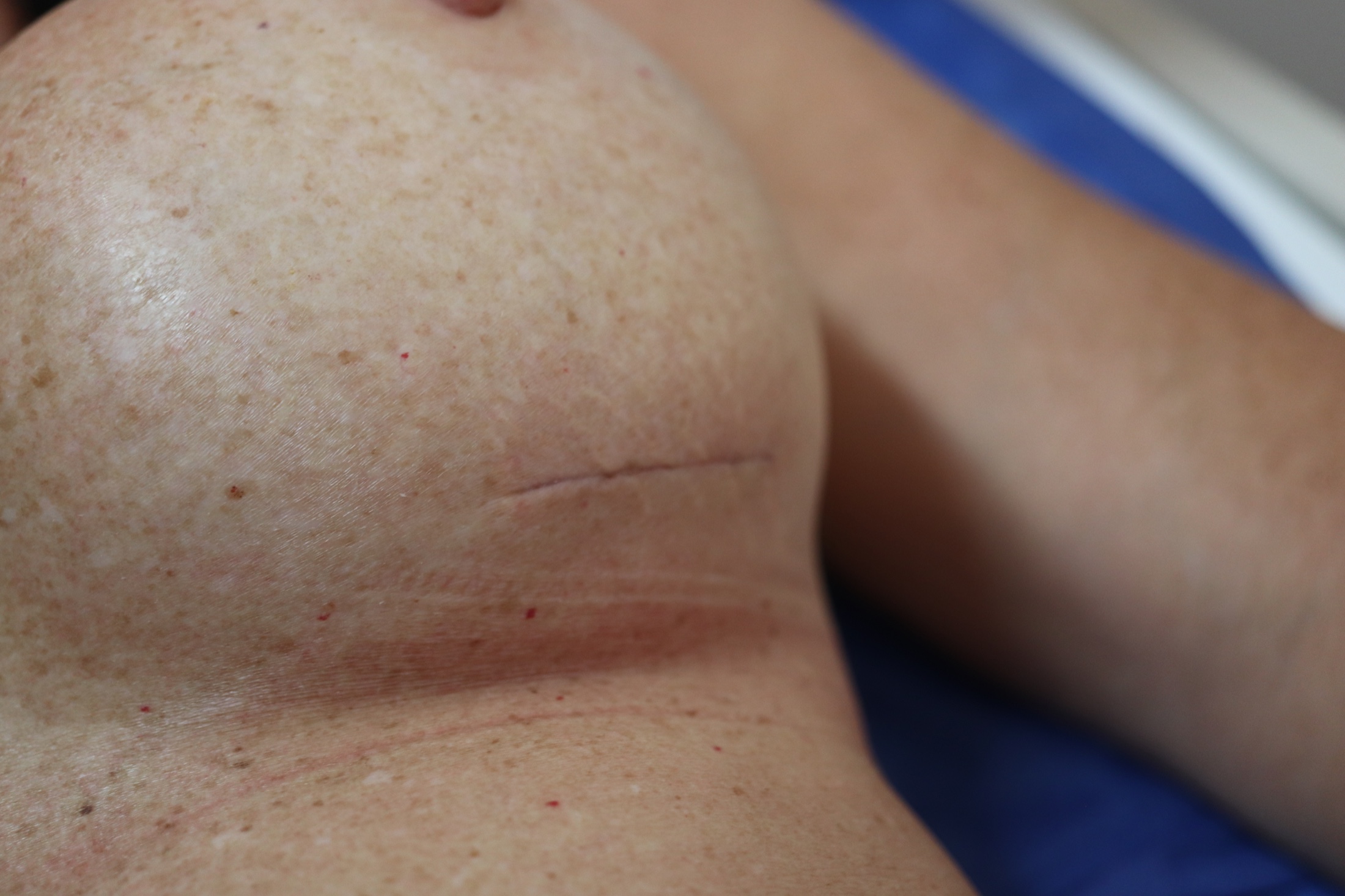 De-identified close-up photograph of a healed inframammary fold scar