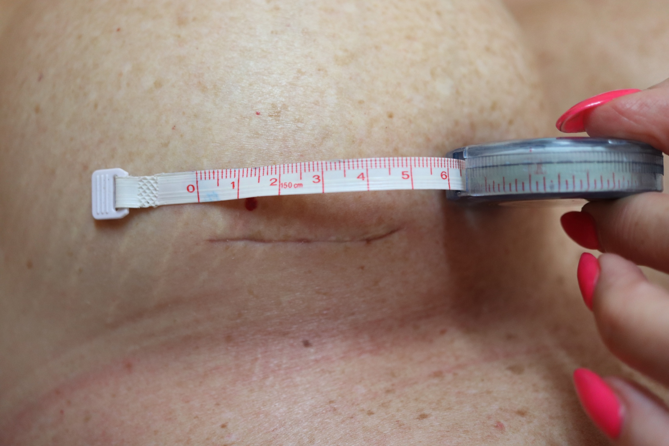 De-identified close-up photograph measuring an inframammary fold scar