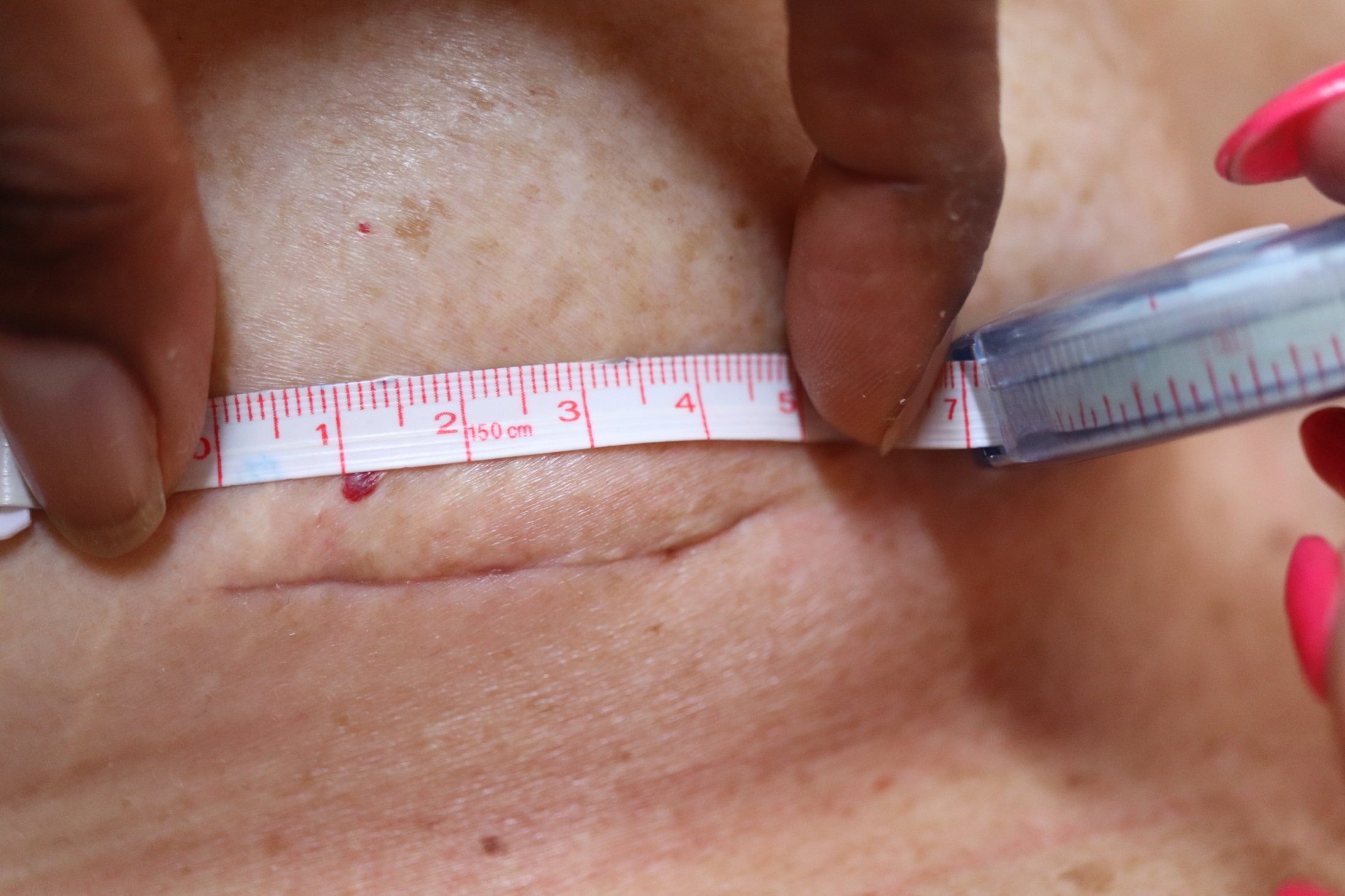 De-identified close-up photograph measuring an inframammary fold scar