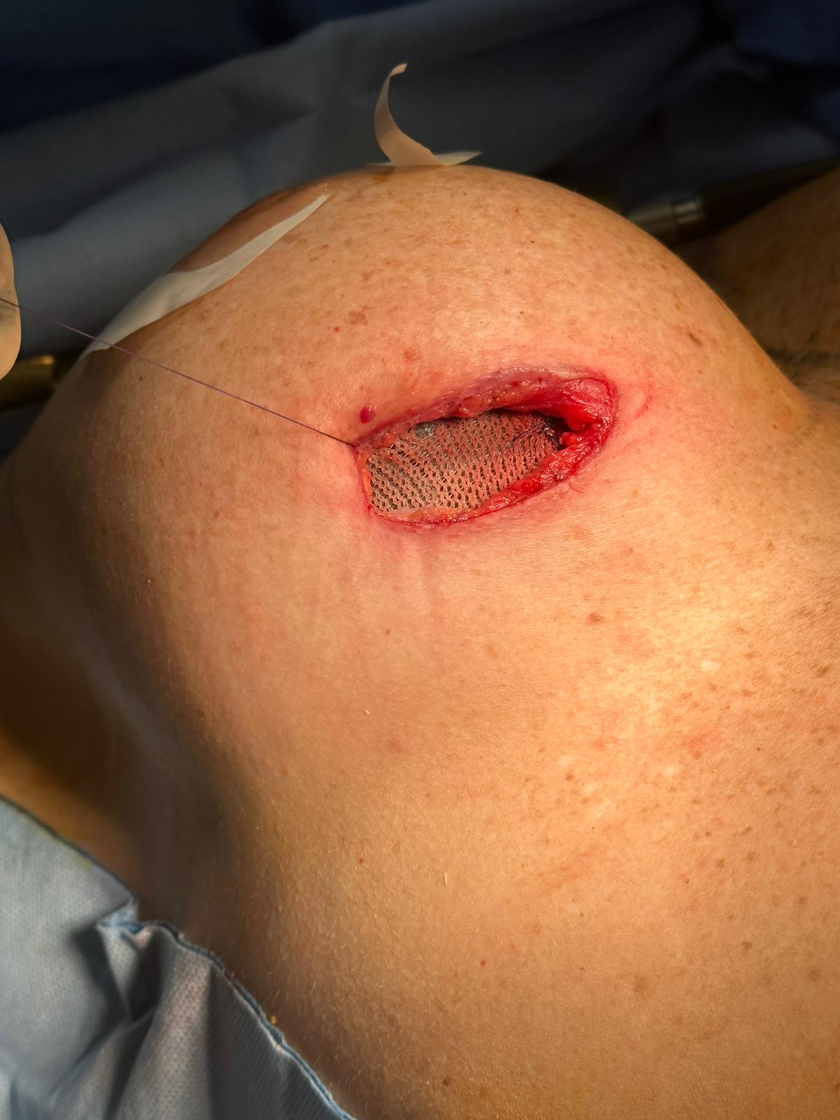 Intra-operative photograph showing TIGR mesh visible through the inframammary incision